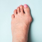Bunion in foot. Valgus deformation from narrow shoes